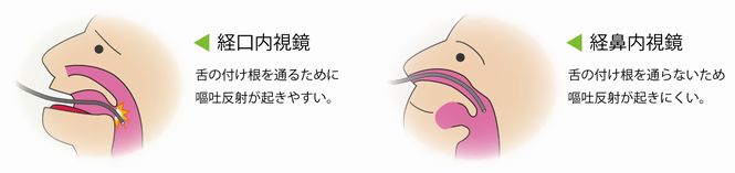 苦痛の少ない鼻からの内視鏡検査（経鼻内視鏡検査）